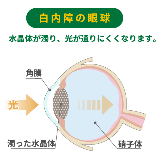 白内障の眼球