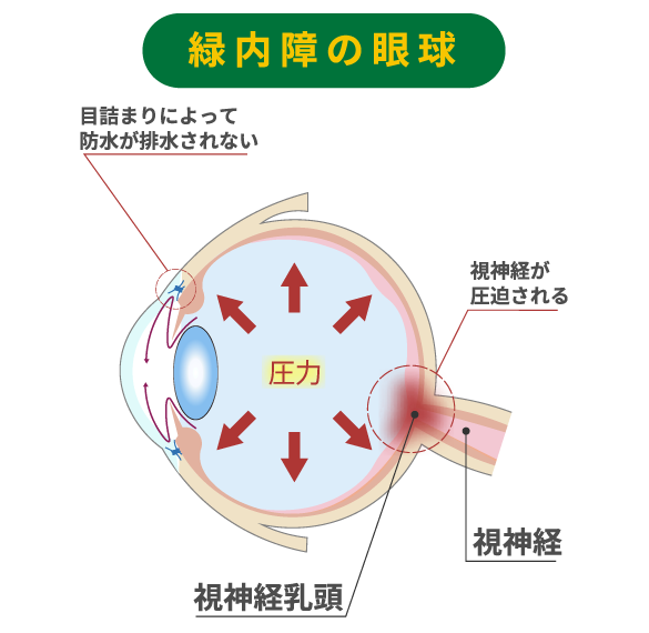 緑内障の眼球